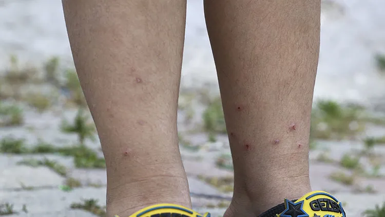 sinek-isirigina-akliniza-gelmeyecek-cozum-hepimizin-mutfaginda-gozumuzun-onundeymis-1721235430729.jpg Sinek ısırığına aklınıza gelmeyecek çözüm! Hepimizin mutfağında gözümüzün önündeymiş-4