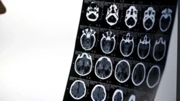 Rusya'da nefes alamayan adam kafasını deldi-3