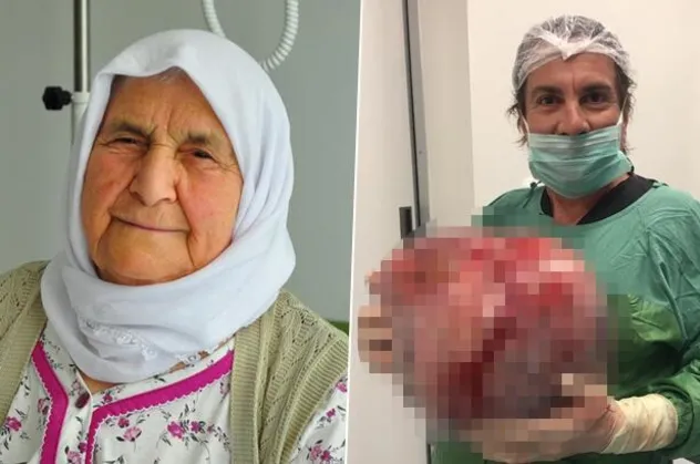 Kilo aldığını sanan yaşlı kadının karnından 12 kilogram ağırlığında yumurtalık kisti çıkartıldı