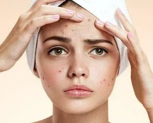 Vücudunuzdaki sivilceleri sakın sıkmayın!