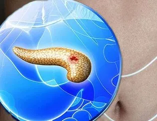 pankreas kanseri nedir pankreas