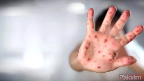 Küresel maymun çiçeği vakalarında artış! DSÖ son verileri duyurdu: Maymun çiçeği nasıl yayılıyor? Hastalığın belirtileri neler? - 4