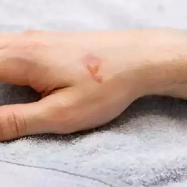 Yanığa bir şey sürmeyin