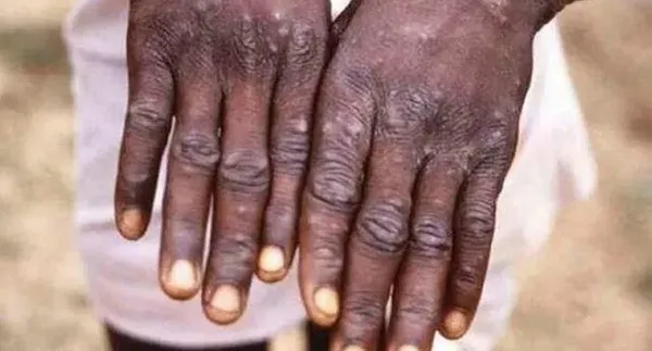 son-dakika-bakan-kocadan-flas-maymun-cicegi-aciklamasi-turkiyede-ilk-vaka-1656571699471.jpg SON DAKİKA! Bakan Koca'dan flaş maymun çiçeği açıklaması! Türkiye'de ilk vaka! Maymun çiçeği hangi ilde görüldü?-7