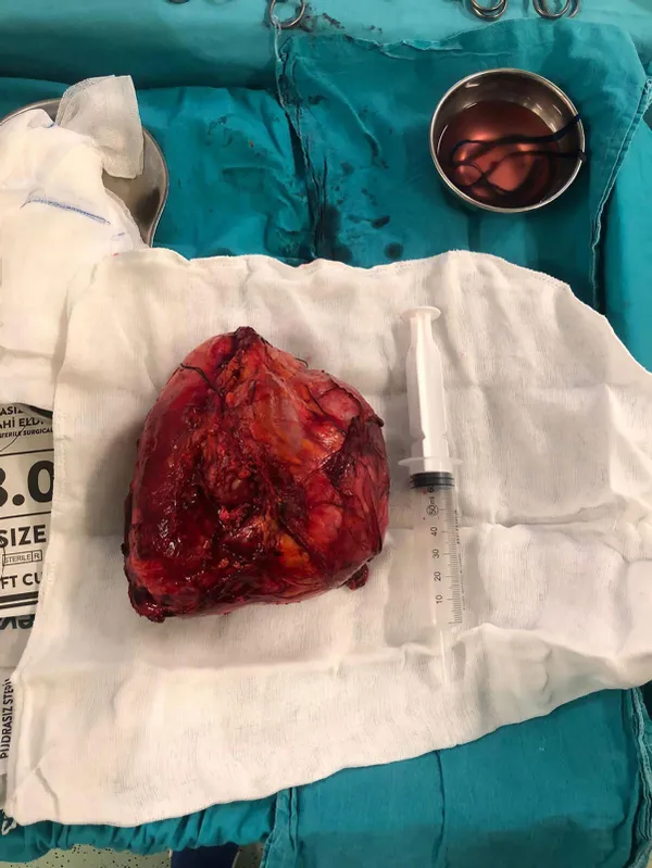 halsizlik-ve-bas-donmesi-sikayetiyle-gitti-karnindan-20-santimlik-kitle-cikarildi-1649935747790.jpg Halsizlik ve baş dönmesi şikayetiyle gitti karnından 20 santimlik kitle çıkarıldı-6