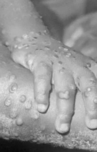 Maymun çiçeği virüsünde ilk karantina başladı! Bir haftada 3 vaka tespit edilen Belçika'dan flaş karar