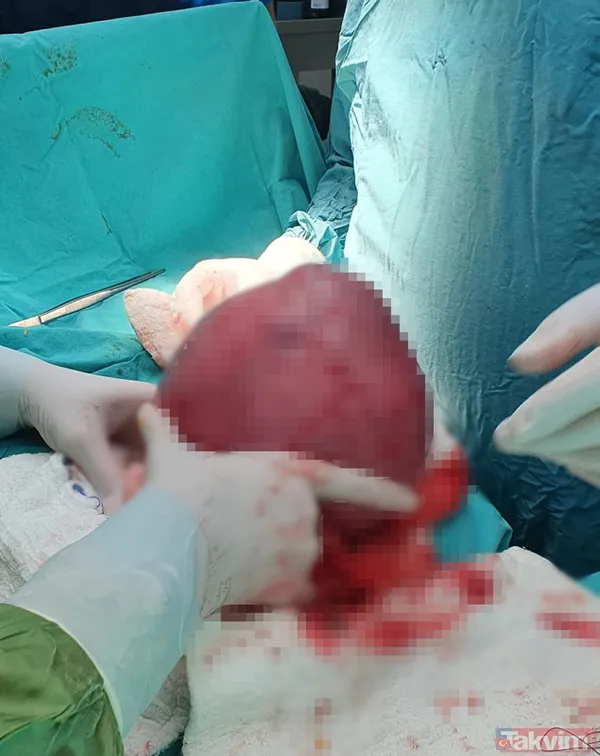 Doktorlar bile şaşırdı! Karnından 20 santimlik miyom çıktı - 1