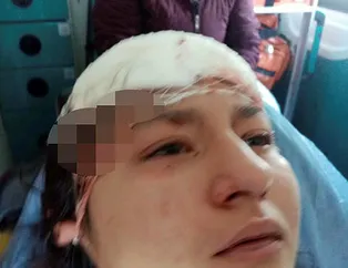 2. Asiye Ateş vakası! Sokak köpekleri yüzünü parçaladı