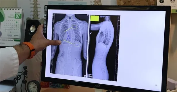 Skolyoz, erken tanı ile tedavi edilebilir!