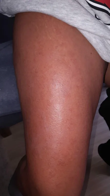 lazer-epilasyon-icin-guzellik-merkezine-gitti-vucudunda-1-derece-yaniklar-olustu-1617716793528.jpg Lazer epilasyon için güzellik merkezine gitti! Vücudunda 1. derece yanıklar oluştu-8