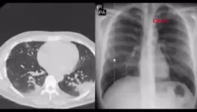 Koronavirüse yakalanan genç doktor 10 günde 8 kilo verdi! Tomografi görüntüsüyle uyardı!