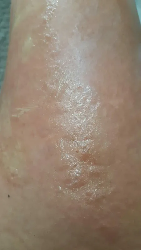 lazer-epilasyon-icin-guzellik-merkezine-gitti-vucudunda-1-derece-yaniklar-olustu-1617716794927.jpg Lazer epilasyon için güzellik merkezine gitti! Vücudunda 1. derece yanıklar oluştu-3