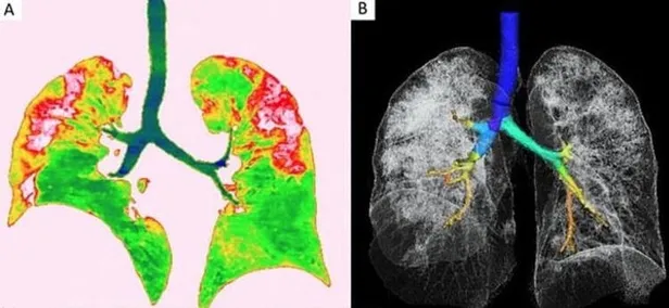 Koronavirüs ciğerleri bu hale getiriyor! Röntgen filmleri dehşete düşürdü!-3