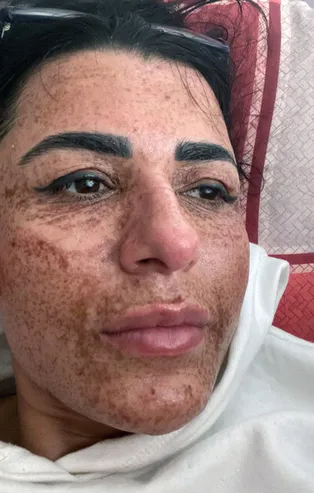 8 ay önce güzellik merkezinde yüzü yanan kadın tedavi sonrası artık aynaya bakabiliyor