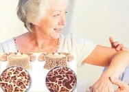 Kemik erimesi kadın düşmanı! Osteoporozdan korunmanın sırrı...