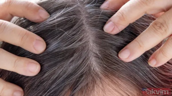 Saçlarınız neden erken beyazlıyor? Genetik mi, stres mi? Cevabı şaşırtacak… - 4