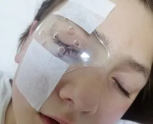 Babasıyla yastık savaşı yaparken gözüne avizedeki çam parçaları isabet etti! Doktorlar gözü yerinde tutmaya çalışıyor