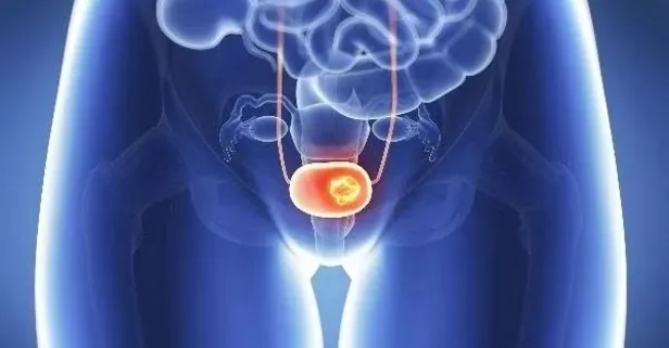 İdrarda kanama mesane kanserine davetiye çıkarıyor!