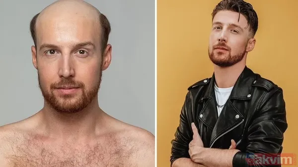 20 Yaşında Saçlarını Kaybettiğinde Hayatı Karardı… Aynaya Bakmak İstemedi, Dışarı Çıkamaz Hale Geldi. Ama Şimdi Görenler Dönüp Bir Daha Bakıyor! Milyonların...