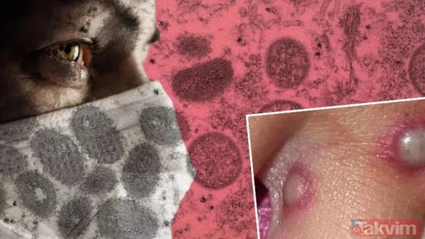 Maymun çiçeği nedir? Belirtileri neler? Çiçek aşısı Maymun çiçeğinden korur mu? Türkiye’de vaka görüldü mü? Sağlık Bakanlığı açıkladı - 4