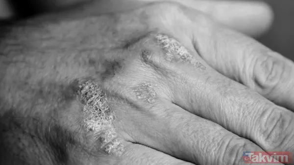 Güneşe Doğrudan Maruz Kalmaktan Kaçının, Şapka Ve Gölgede Kalın. Stresinizi Hafifletmek İçin Meditasyon, Yürüyüş Gibi Yöntemleri Deneyin. Yeni Ürün Denemeden...