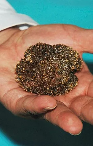 Mesanesinde 220 gramlık tek parça taş çıktı