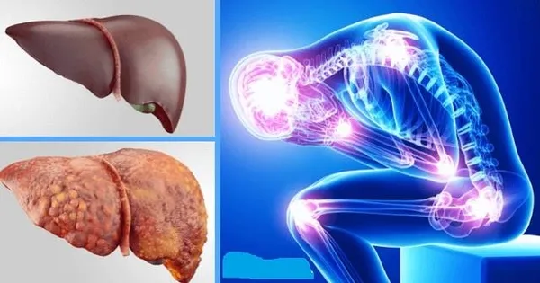 Karaciğer yağlanması nedir? Karaciğer yağlanmasından nasıl korunulur? Uzman isim sıraladı-2