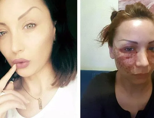 Estetik faciası! Bulgar model hayatının şokunu yaşadı!
