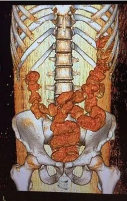 Midesinden uyuşturucu çıktı