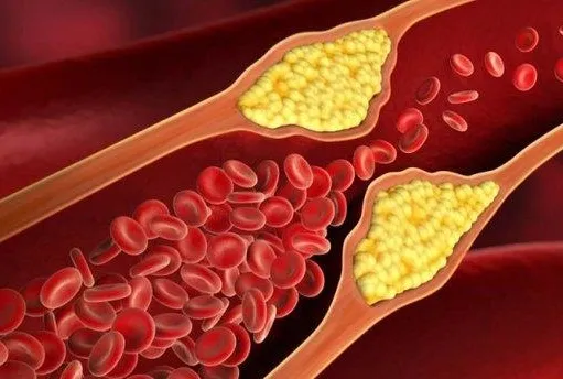 6 adımda kolesterolü düşürün