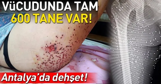 Dehşeti yaşadı! Vücudunda tam 600 tane var...