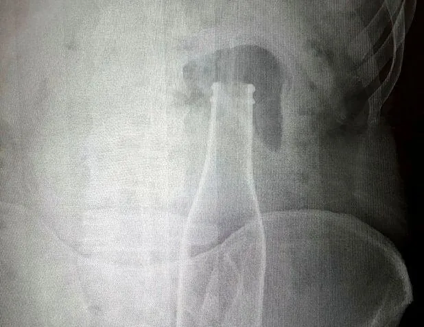 Vücudundan şişe çıkan genç: Yanlışlıkla oldu