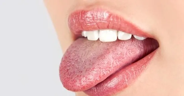Uzmanı uyardı: Dildeki renk değişiminin birçok farklı nedeni var!