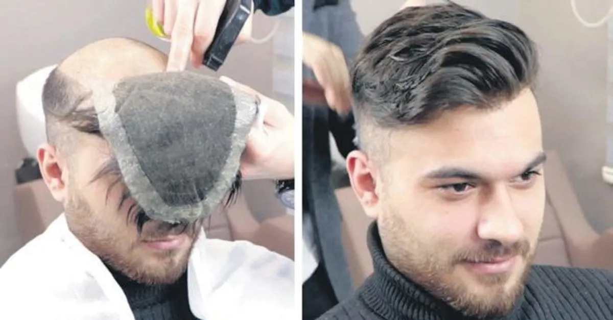 peruk ve protez sac satislari patladi 700 lira istediler takvim