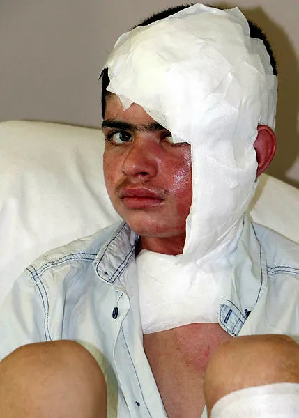 karsta-buzagi-otlatirken-kopan-yuksek-gerilim-akimina-kapilan-ebubekirin-ayak-tabanlari-patladi-1594805752642.jpg Kars'ta buzağı otlatırken kopan yüksek gerilim akımına kapılan Ebubekir'in ayak tabanları patladı-2