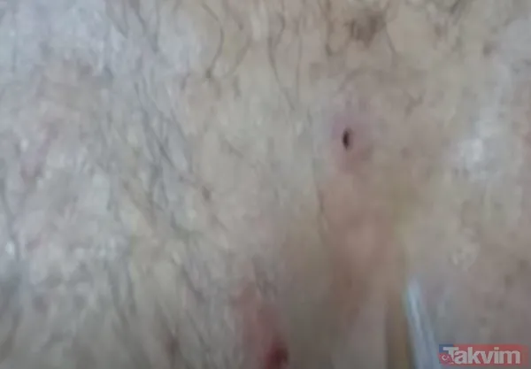 Karnındaki şişlik için gitti içinden çıkan doktorları bile şoke etti! Yer uzak değil Kayseri! 64 kilo girdi 55 kilo çıktı - 45