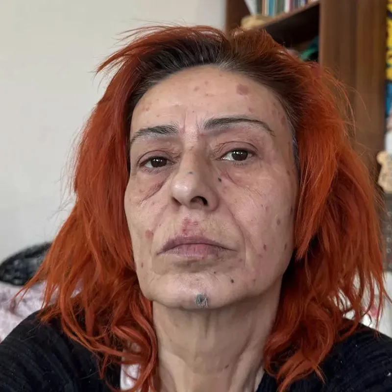 yildiz-tilbenin-dogal-sac-boyasi-tarifi-4-malzemeli-formulu-acikladi-1776752384188.jpg Yıldız Tilbe’nin alerji kabusu bitti! İşte yüzünü güldüren 4 malzemeli mucize formül-3