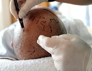 Saç ekimi ölüme götürdü