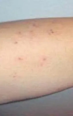 Kansere karşı sağ koldaki benlere dikkat