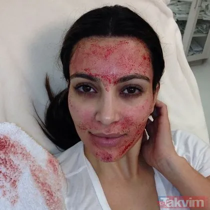 Kim Kardashian’a özenmişlerdi: Vampir botoksu sonları oldu! Uzmanlardan uyarı: Yaptıran HIV’e yakalanıyor