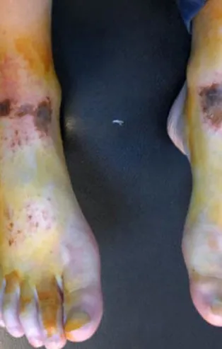 Afyonkarahisar'da kar topu oynadıktan sonra vücutlarında yanıklar oluşmuştu! Nedeni belli oldu!