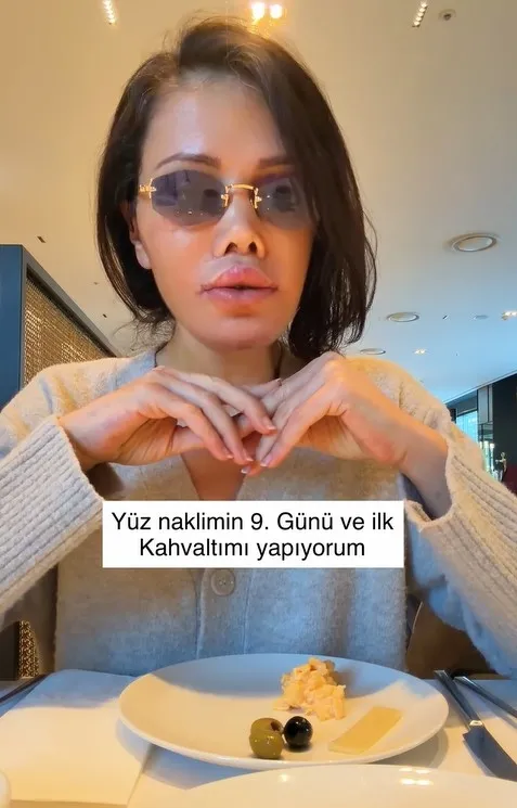 guney-korede-yuz-nakli-yaptiran-didem-ceranin-son-hali-1771060767298.jpg Güney Kore’de yüz nakli yaptıran Didem Ceran’ın son hali-5