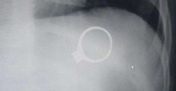 Sivas'ta 1,5 yaşındaki bebek annesinin tek taş yüzüğünü yuttu