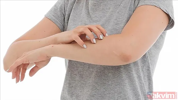 Egzama, sedef, kaşıntı… Canan Karatay cilt hastalıklarının gerçek nedenini açıkladı - 5