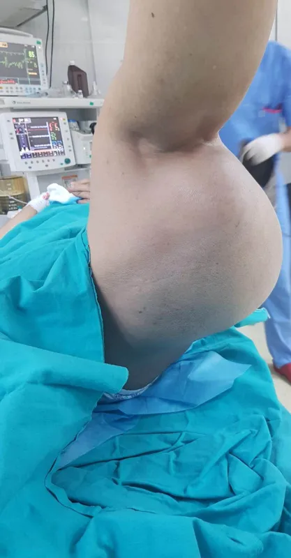 diyarbakirda-72-yasindaki-kadin-korona-nedeniyle-15-yil-hastaneye-gitmedi-uylugundaki-5-kiloluk-tumor-ameliyatla-alindi-1624005699688.jpg Diyarbakır'da 72 yaşındaki kadın korona nedeniyle 1,5 yıl hastaneye gitmedi! Uyluğundaki 5 kiloya ulaşan tümör ameliyatla alındı-5