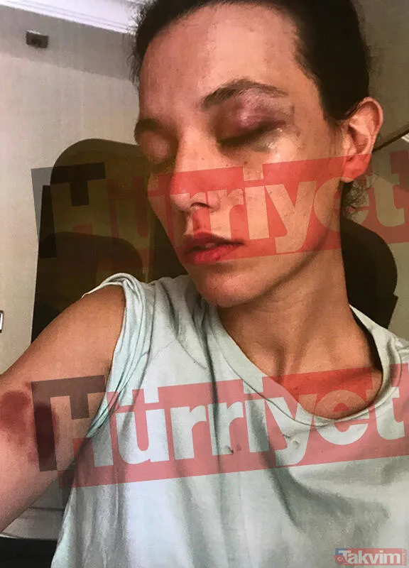 Bulutsuz Şikâyet Dilekçesinde Şöyle Konuştu: "Bu Söze Bozulduğumu Söylememin Ardından Alkolün Etkisiyle Bağırıp Çağırmaya Başladı. Onu Sakinleştirmek İsterken...