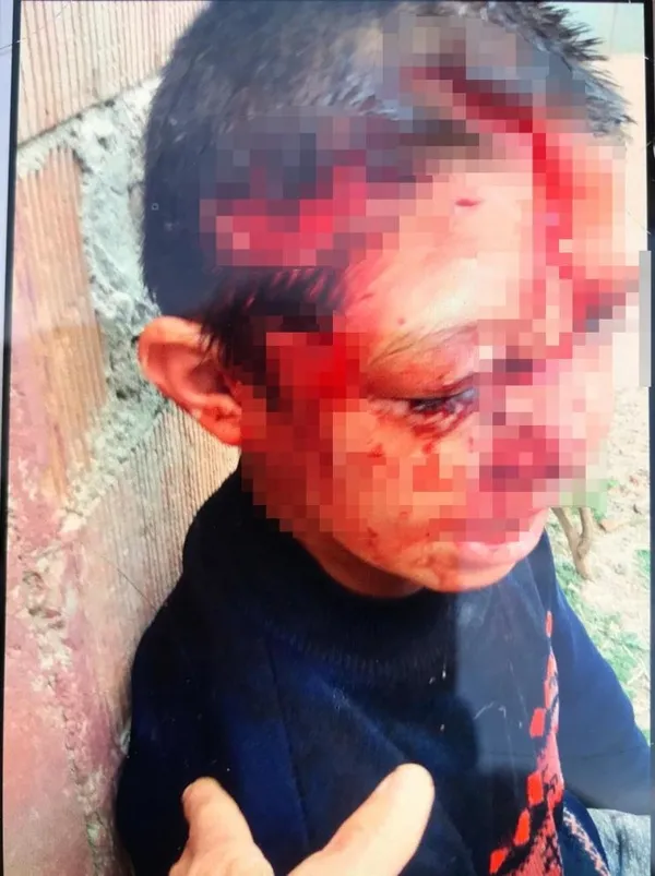 arkadaslariyla-oynarken-komsu-kopeginin-saldirisina-ugrayan-8-yasindaki-sevket-olumden-dondu-1621670147779.jpg Arkadaşlarıyla oynarken komşu köpeğinin saldırısına uğrayan 8 yaşındaki Şevket ölümden döndü-3