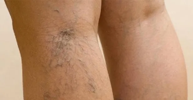 Bacak ağrısı, yanma ve kramplar varisin habercisi olabilir