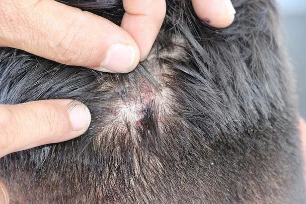 1 cm ile felç olmaktan kurtulan 18 yaşındaki genç: İlk başta çekiçle vurdular sandım-1