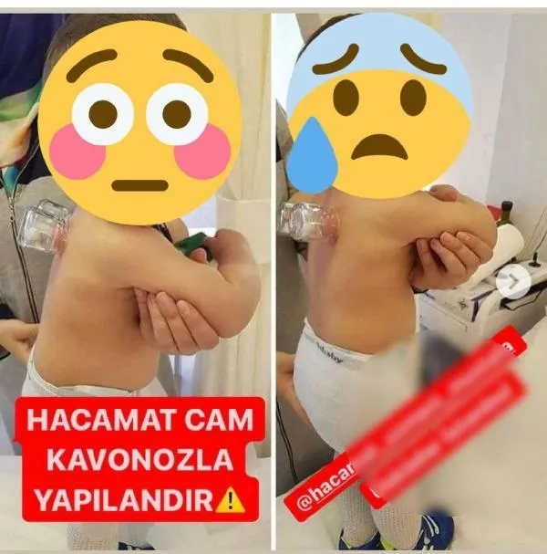 Sosyal medyadaki hacamat görüntüleri olay yarattı: Bebeklere bile yaptılar! Uzmanlardan kritik uyarı-5
